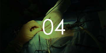 ミニマム創内視鏡下手術