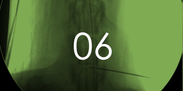 経皮的レーザー椎間板減圧術